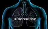 Comment diminuer l’incidence de la tuberculose au Cameroun à l’horizon 2030?